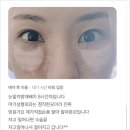 드라마성형외과의원 | 논현성형외과, 눈밑지 보다 더 좋은 수술이?