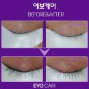 난이손톱