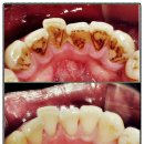 임플란피아치과의원 | 삼성역치과 자연치아를 살리는게 최우선 임플란피아치과