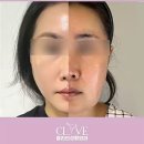 안면거상전문병원을 찾는 이유, 40대 리얼 후기 공개