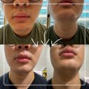 구열남성경로당 | [아이스맨 울트라X5 멘톨비누] 뾰루지가 줄어든 면도비누 후기