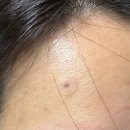 브이맨비뇨기과의원 | 광주 첨단 주말 시술 가능한 쥬네르 의원 점 제거 후기(+재생크림, 점 제거 후 관리)