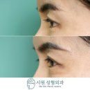 628 뒤트임복원, 밑트임복원 2개월차 후기 : 뒤트임, 밑트임 후 발생한 흉터와 안구건조등을 완화 at...