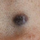 맑고고운의원 수원점 | 수원 점빼는곳, 인중에 생긴 왕점을 제거한 후기