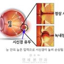 실명을 유발하는 녹내장 초기증상과 예방법을 알아보자 이미지