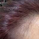선헤어라인 이미지
