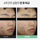 데일리 여드름 케어, 뾰루나 세럼으로 트러블 피부 진정 시키기!
