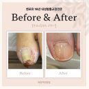 엔포유 | 충주 내성발톱 교정 전문, 16년 경력 엔포유네일 실제 시술 후기