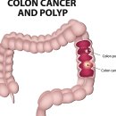 "대장암, 발생 부위 따라 생존율 차이" - 혈관 조영술, 암 수술... 의학 이라는 괴물, 인간이라는 기물/ 사탄, 악마, 독사의 자식들... 이미지