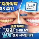 더블유티치과기공소 | 강남 논현역 치아미백 치과 가격 및 후기