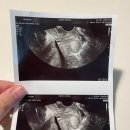청해미용실 | [임신 28주~31주] 입체초음파/역아/백일해접종/경부길이/뇌실/머리큰아기/계대동산병원