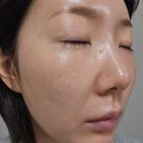 멍베스트 | 강남역 엘라비에 리투오 수면마취 후기, 수면마취 무료, 가격, 1달 후기, 유지기간, 멍, 효과