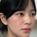 샤인광고 | 청담 쥬베룩스킨 더마샤인 통증 다운타임 솔직 후기