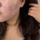 차명수연세피부과의원 | [연세바비의원] - 대구동성로 피부과 인모드 시술 후기/멍/효과/1주일 후기