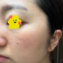강서열린약국 | 강서구 편평사마귀 제거 시술 후기 및 시술 전후 비교 시술 후 관리 팁 | 원장이 셀프 편사제거하고...