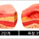 욕창의 단계에 따른 치료법 이미지