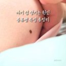 미나반점 | 아기 점 왜 생길까? 원인 시기 및 모반 종류별 특징