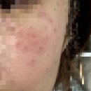 웰피부과의원 | 익산 피부과 3곳 점, 편평사마귀, 잡티제거, 수염레이저제모 내돈내산후기