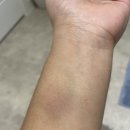I got bruised at work 😭😭 (tw bruise) 이미지