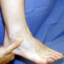[발목염증]발목인대손상이면 발목염증치료 서두르자. - 퇴행성관절염수술전문 연세사랑병원 이미지