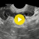 seminal vesicle cyst(정낭 낭종)-rectal sono 이미지