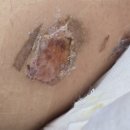 곧바로병원 | 화상치료후기 2도 표재성 흉터치료 메디폼 흉터연고 사용시기