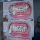 디퍼스트치과의원 | 강남 치아미백 원데이 디퍼스트치과의원 치아미백 비용 합리적인 곳 강남 치아미백치과 추천 + 본식...
