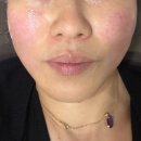 속편한 곽내과의원 | [명동피부과] 텐트리플 고현정리프팅 추천 - 리얼 솔직 후기