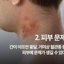 간 안좋을때 , 원인과 간 건강 관리 음식 알아봐요 이미지