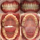 얼굴에미소치과의원 | 돌출입 아닌데 교정하면 입 들어가나요? 얼굴 변화 없이 덧니만 교정하는 비발치 교정 송파 교정치과