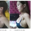 ♭가슴성형 11일째♭ 윗가슴이 볼록~~360도 꽉채워지다! 이미지