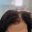 김해중앙병원 앞 | [김해 가발 후기] 정수리 탈모 고민 끝! 앞머리 올리는 가발 스타일 리얼 전후