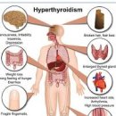 갑상선 기능 알고 갑성선기능 항진증 원인 증상 정리 이미지
