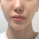 쥬베룩 모공 관리하려고 피부과 손주사 시술 통증 참은 리얼 후기