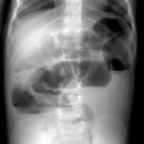 장마비[Paralytic ileus] 이미지