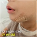 태사랑 태권도장(운동치료) | 8세 열상 봉합, 얼굴 찢어진 상처 꿰맨 후 관리방법