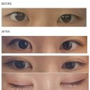 자연유착 쌍수 후기｜비절개 쌍꺼풀 수술 솔직 리뷰