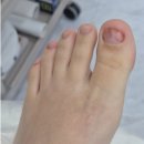 이뻐지는날스킨케어 | 마포 무좀 케어 넘버원 레푸스 망원점 - 무좀균 박멸을 위한 5개월간 내돈내산 케어 과정, 후기