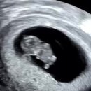 근원의료재단 | [임신 13~14w] 니프티검사 결과, 2차 정밀초음파(코뼈 안보임 후기), 임신 초기 코로나 확진