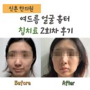 바름한의원 | [💸내돈내산] 신촌한의원 여드름 얼굴 흉터 침치료 받은후 피부결 부터 달라졌어요 (+회복과정 후기)