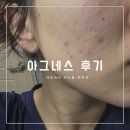 아그네스 | 제주 여드름 피부과 아그네스 내돈내산 후기 당일(1일차) - 3일차