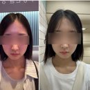 자연알로(성남) | 성남 얼굴윤곽주사 내돈내산 효과부터 붓기까지 총정리 경과후기