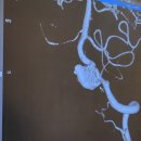 (주)퓨쳐켐헬스케어-서울성모병원 | 큰 뇌동맥류 15mm 시술 2년 후 시야 장애 어지러움 증상 MRA 결과 비용 실비 보험 혈류변환스텐트 코일...