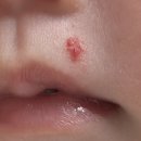 구자훈소아과의원 | 대구 이석종피부과 아기 얼굴 혈관종 진료 후기/치료/경과(바르는약_리스몬티지)