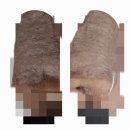 코&태 | 코 전체제거 7일차 후기 테이핑제거 및 실밥제거 - 콧대가 네모난데 이게 제 코가 맞다고요!? 상실감...