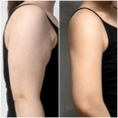 워너비영등포구센터 | 팔뚝 지방추출주사 가격 및 5주차 솔직후기! 식단부터 통증 사후관리 총 정리✨