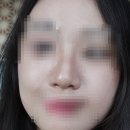 굳건병원 | 여자 매부리코 비개방 코성형 후기 (대성공 대만족 / 전후사진O)