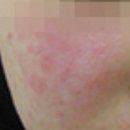 햇빛고운한의원 | 로하셀한의원 후기 ! 지루성피부염때문에 다녀옴~