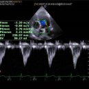 Aortic Stenosis 이미지