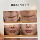 시흥배곧 피부과추천 슈링크500샷 2회차 내돈내산 후기